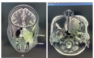 Đau hàm, nghẹt mũi, chảy máu răng - Đi khám phát hiện ung thư xoang