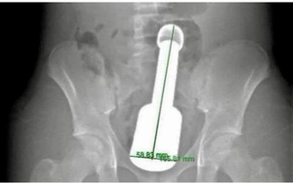 Chày kim loại kẹt trong trực tràng: Tuổi dậy thì và tâm lý 'một mình, thử xem sao'