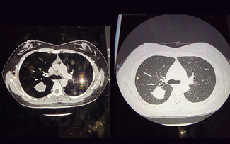 ‘Mắt thần’ trong tầm soát ung thư phổi: Một nốt mờ nhỏ thay đổi tiên lượng sống