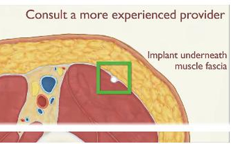 Bệnh viện Phương Nam xử trí ca que tránh thai xuyên sâu vào cơ hiếm gặp