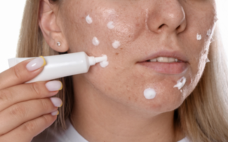Vì sao nhiều người trị sẹo mãi không hiệu quả dù rất chăm skincare?