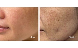 5 kem giúp mờ nám, da trắng sáng sau khoảng 4 tuần, kể cả nám hỗn hợp