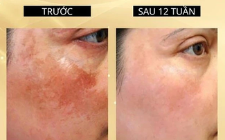 +7 kem mờ nám giúp da sau sinh vẫn trắng hồng rạng rỡ, mẹ tự tin hơn