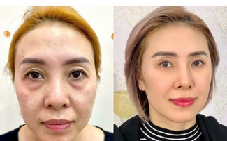 Xóa tan quầng thâm mắt bằng công nghệ Hydro Ultra Lift