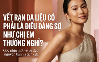 Rạn da liệu có phải là điều đáng sợ như chị em vẫn nghĩ?