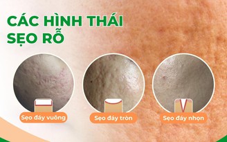 Sẹo rỗ và các phương pháp điều trị không phẫu thuật: Đường đến vẻ đẹp tự tin