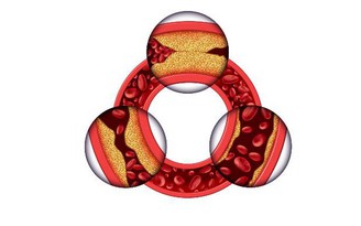 Liệu Pháp Plaquex - Giảm xơ vữa động mạch và ngăn ngừa đột quỵ