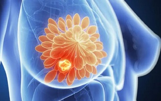 Phụ nữ cần làm gì để giảm nguy cơ ung thư?