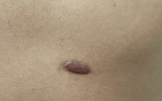 Bác sĩ nêu nguyên nhân tiềm ẩn lây lan bệnh giang mai trong cộng đồng