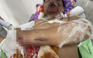 Đắk Lắk: Cứu bệnh nhi bị dập nát 2 bàn tay nghi do pháo nổ