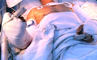 Bệnh viện Chấn thương chỉnh hình TP.HCM cứu bệnh nhân bị máy cắt lìa 2 cẳng tay
