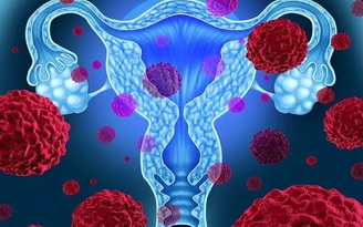 Người phụ nữ mắc hàng trăm khối u khiến bụng phình to như mang thai 20 tuần