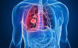 4 dấu hiệu ngay khi thức dậy cảnh báo bạn có thể mắc ung thư phổi