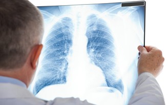Ngày mới với tin tức sức khỏe: 4 lầm tưởng về ung thư phổi