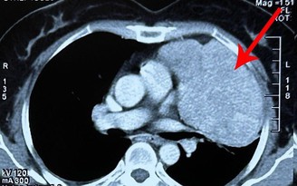Nữ bệnh nhân phát hiện u phổi ác tính khi đi mổ ruột thừa