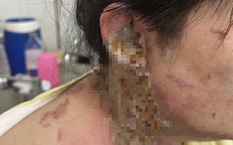 Một phụ nữ bị tạt a xít khi chạy xe máy trên đường