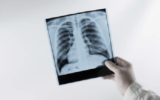 Vì sao nhiễm cúm A có thể khiến phổi trắng xóa?
