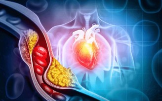 Dấu hiệu cholesterol cao đã chuyển thành bệnh nguy hiểm