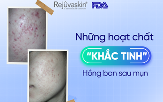 Top những thành phần 'khắc tinh' hồng ban sau mụn