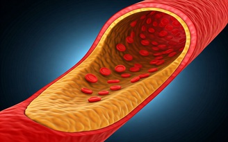 Tại sao xơ vữa động mạch được gọi là ‘kẻ giết người thầm lặng’?