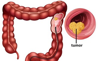 Loại quả ngon ngọt được phát hiện có khả năng ngăn chặn ung thư đại trực tràng