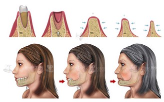 Implant cá nhân hóa, ‘cứu tinh’ của các trường hợp mất răng, tiêu xương hàm trầm trọng