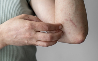 Ngày mới với tin tức sức khỏe: Bỗng dưng ngứa da là dấu hiệu bệnh gì?