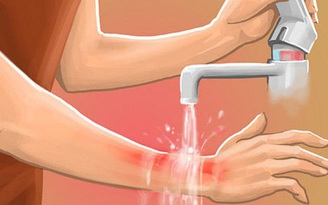 Bị bỏng nên làm gì để không bị sẹo xấu?