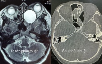 Mất thị lực gần như hoàn toàn vì u nhầy 'khổng lồ' hiếm gặp