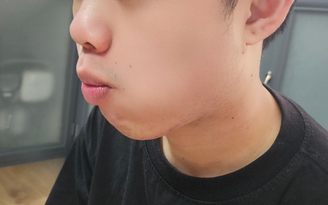 Hay nhai một bên khi ăn: Tưởng vô hại nhưng… nhiều tác hại!