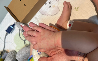 TP.HCM: Trẻ sốt không hạ, đi khám bác sĩ phát hiện mắc bệnh hiếm gặp