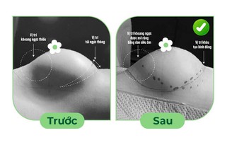 Bác sĩ Hồ Cao Vũ lựa chọn tháo túi ngực mê mask thanh quản