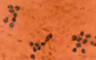 Viêm màng não do não mô cầu: Cả nước 84 ca mắc, 1 ca tử vong