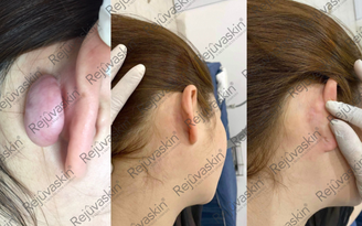 Nâng cấp hiệu quả điều trị sẹo lồi với lời khuyên từ chuyên gia da liễu