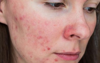 Vì đâu tổn thương da do mụn kéo dài mãi không hết?