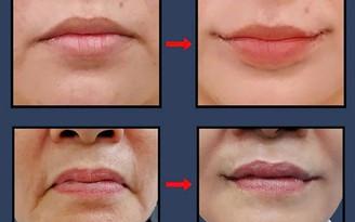 Smile Lipt bí quyết tạo khóe môi cười tự nhiên của bác sĩ Bảo Tiên