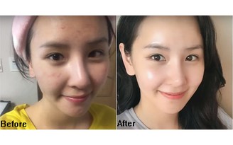 Top 10 kem chống nắng cho da mụn: Ai dùng rồi cũng nguyện chung thủy tới già