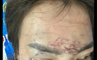 Cà Mau: Một phụ nữ tố bị bắt, đánh đập, xăm mặt, tạt axit vì ghen