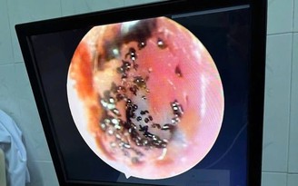 Ve chó ký sinh, làm tổ và sinh sản trong ống tai bé trai