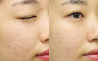 Top 10 kem trị mụn viêm hiệu quả nhanh chóng da sáng ngời, ngăn ngừa sẹo xấu