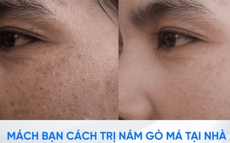 Làm thế nào để trị nám gò má dứt điểm ngay tại nhà, không xâm lấn?