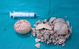 Phẫu thuật lấy sỏi khủng nằm trong người bệnh suốt 30 năm