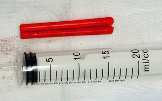 Say rượu ngã úp mặt, đôi đũa nhựa cắm mũi suốt một năm nhưng không biết