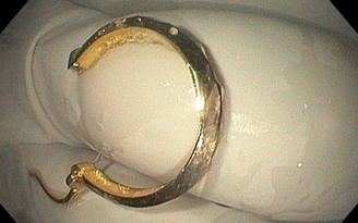 Chiếc khuyên tai 'đi lạc' vào dạ dày bé gái 8 tháng tuổi