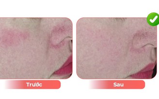 Hiệu quả khi trẻ hóa da bằng ánh sáng tinh khiết