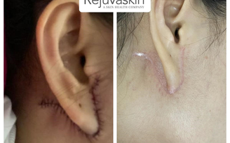 Cách chuyên gia thẩm mỹ sử dụng Rejuvasil để ngăn sẹo thẩm mỹ lồi và phì đại