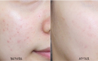 Top 4 sản phẩm trị mụn cấp tốc cho da nhạy cảm, dịu nhẹ không kích ứng