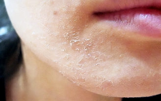 Bỗng một ngày da đỏ rát, bong tróc, phải làm sao?