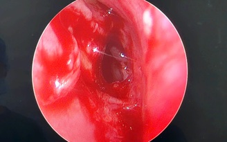 Hiếm gặp: Cụ ông mất hoàn toàn thị lực mắt trái vì khối u nhầy xoang bướm