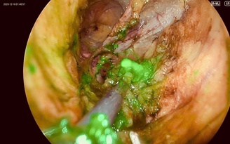 Lần đầu tiên Việt Nam ứng dụng kỹ thuật mới điều trị ung thư phụ khoa